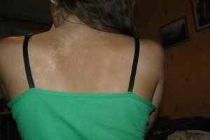 Заболевания кожи с белыми пятнами