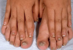 Причины возникновения грибка ногтя